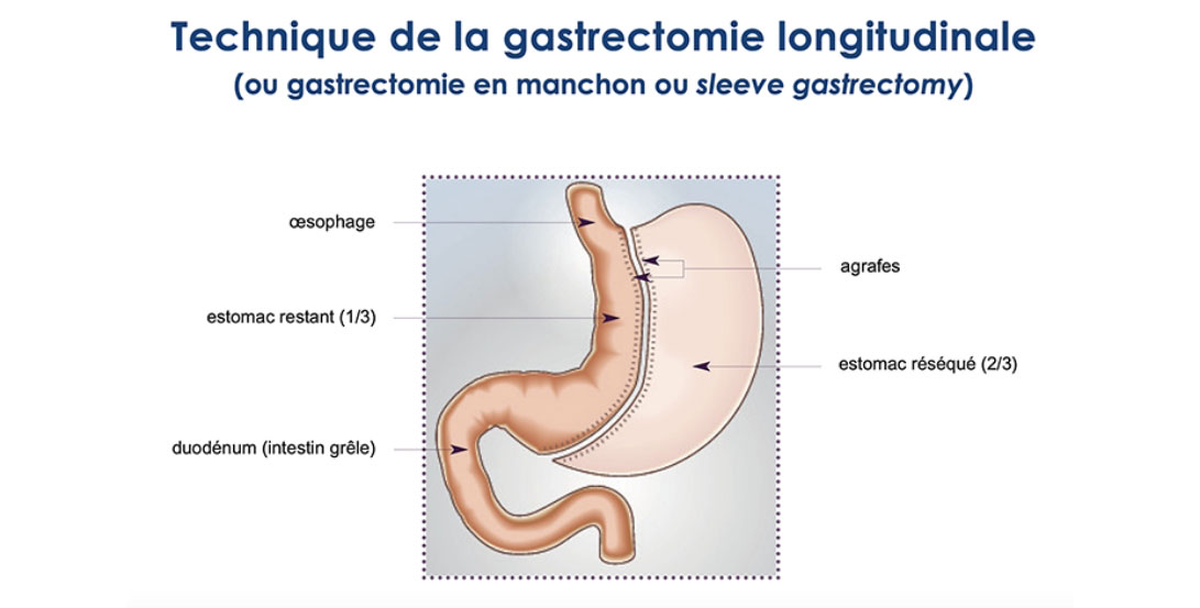 schema d'une sleeve gastrectomy